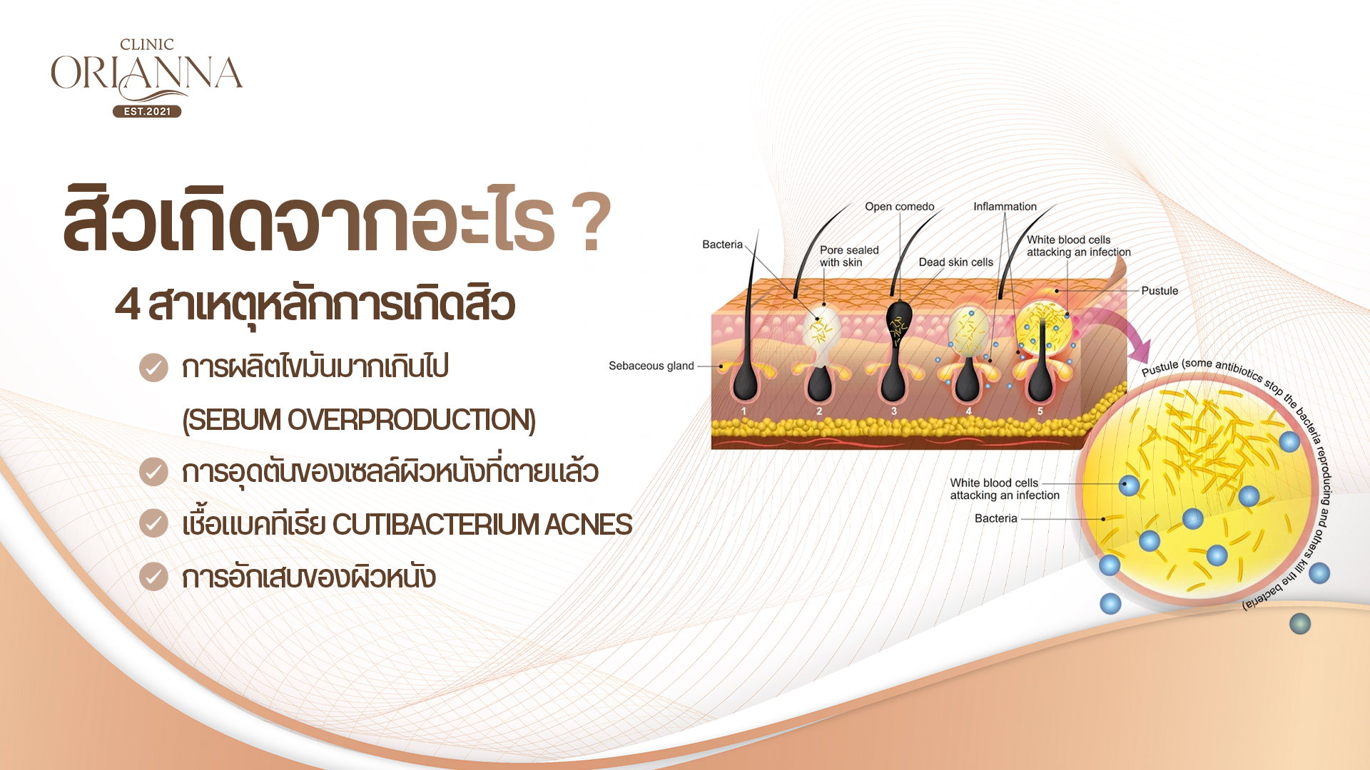 4 สาเหตุหลักการเกิดสิว
