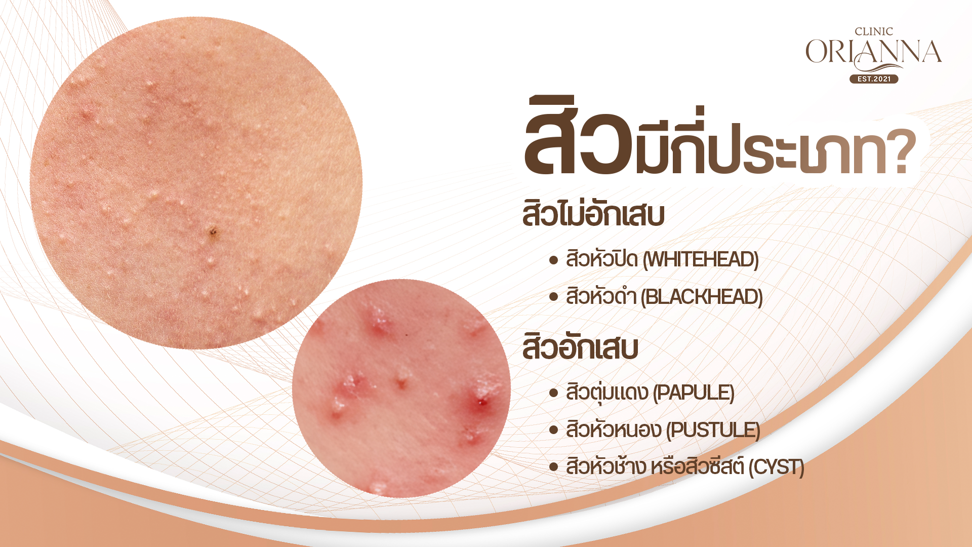 ประเภทของสิว สิวไม่อักเสบและสิวอักเสบ