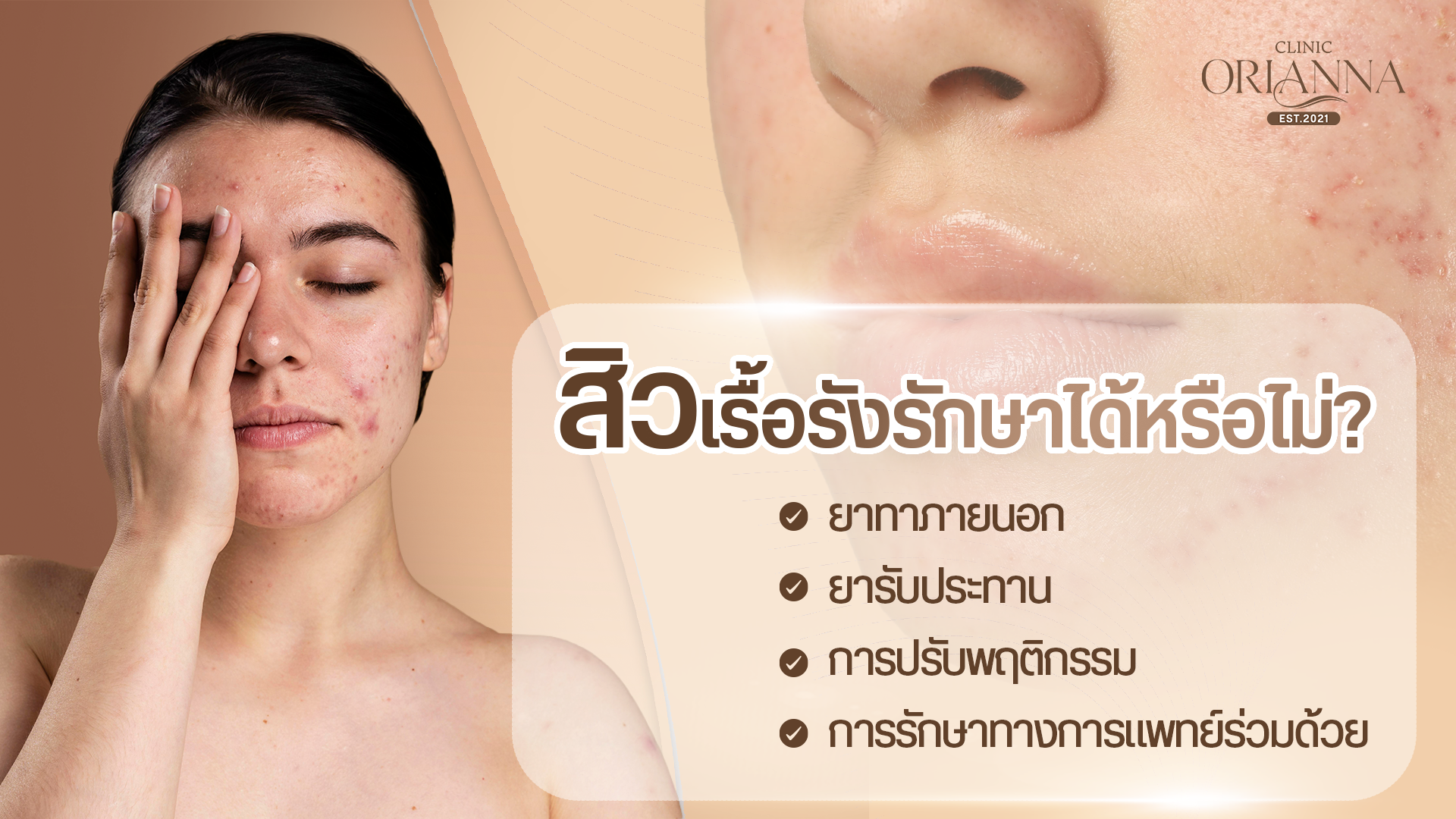 สิวเรื้อรังรักษาได้หรือไม่